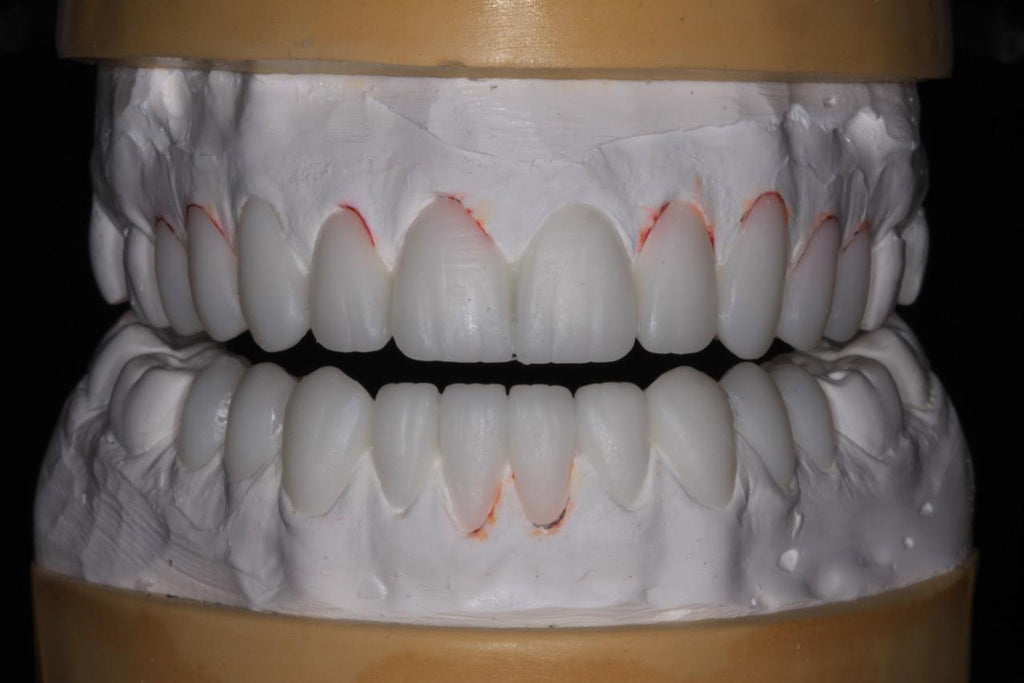 "SmilePreview" Diagnostic Wax-Up Model