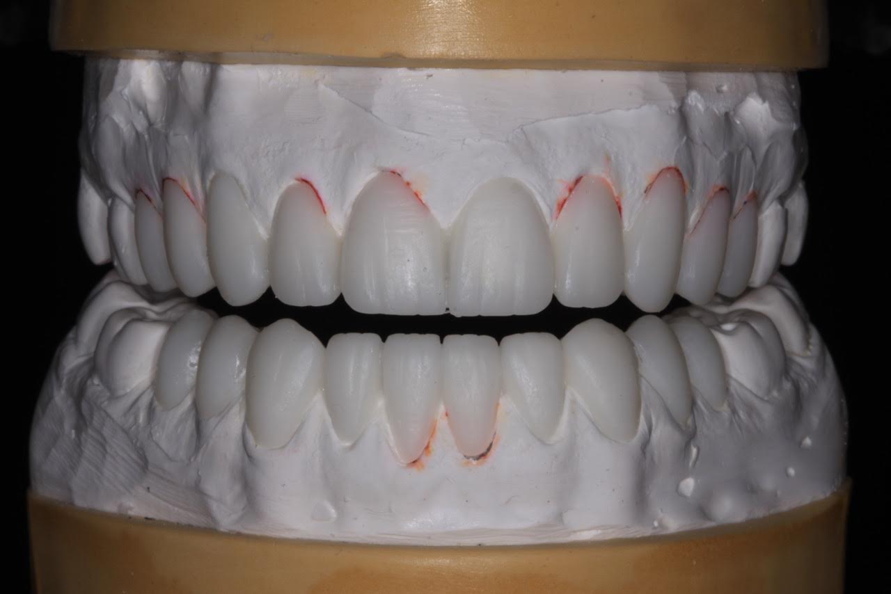 "SmilePreview" Diagnostic Wax-Up Model