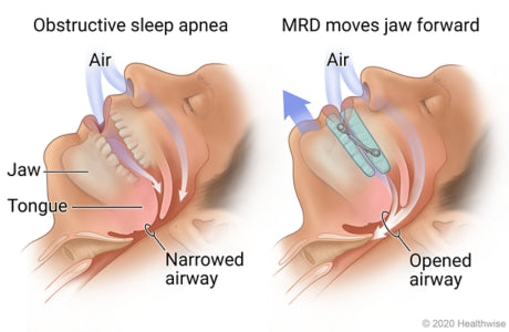 "SnoreGuard" Mandibular Advancement Device