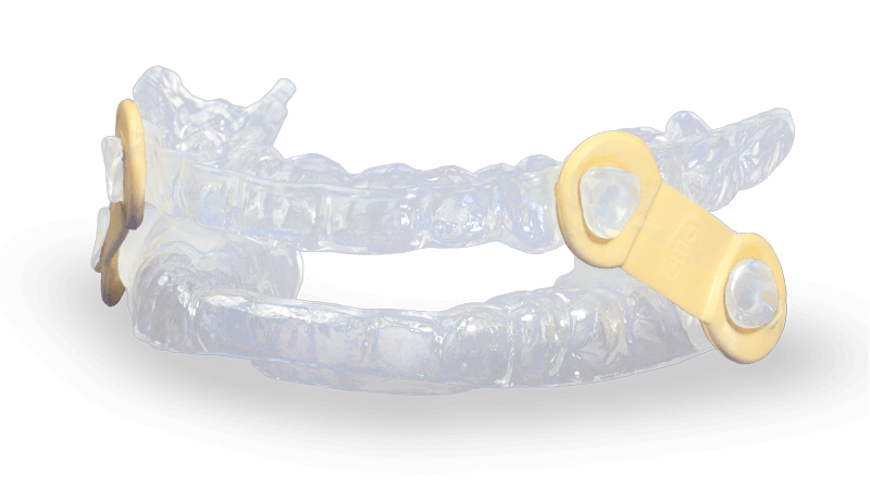 "SnoreGuard" Mandibular Advancement Device