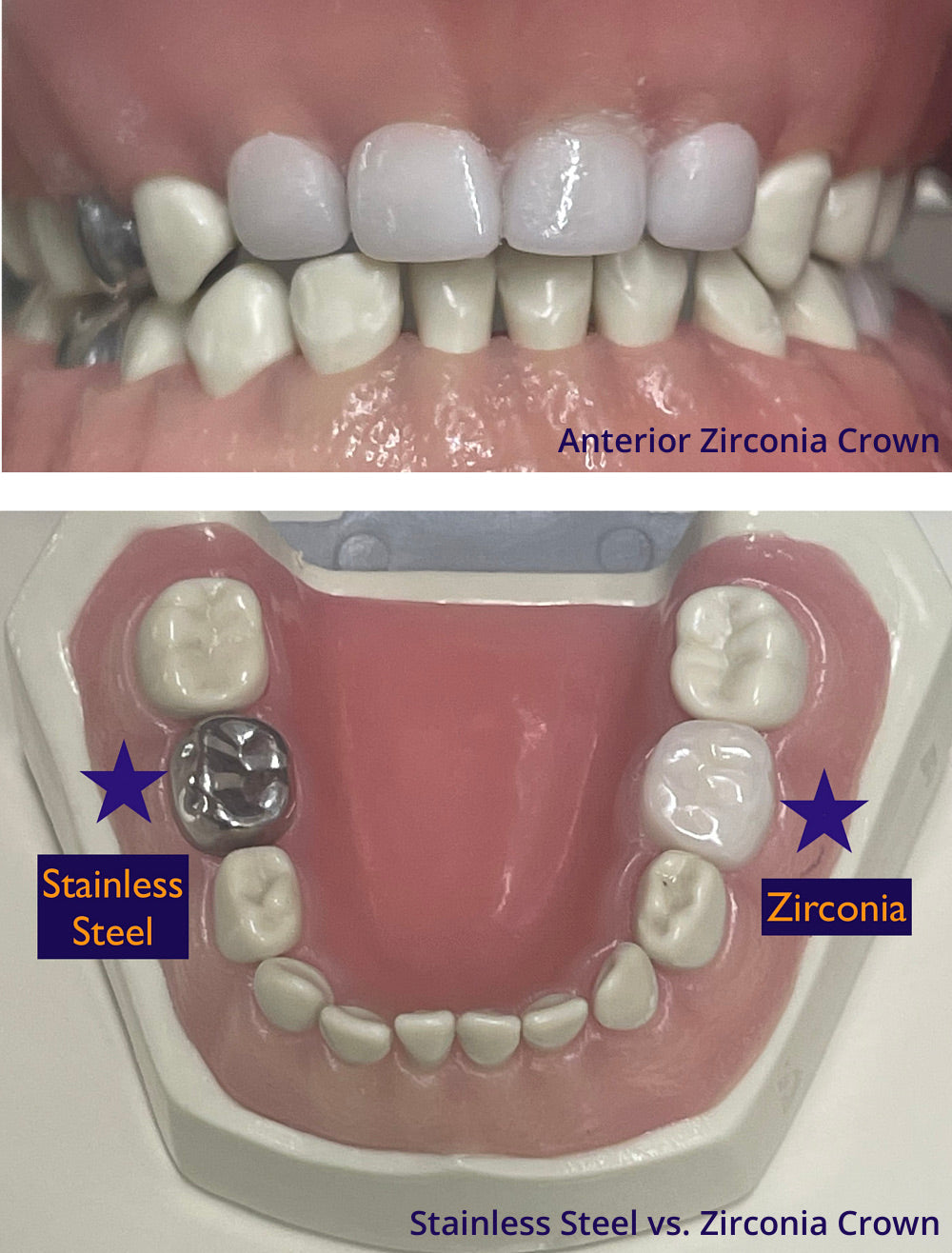 "PediatricZ" Zirconia Pediatric Crown (Pre-formed)